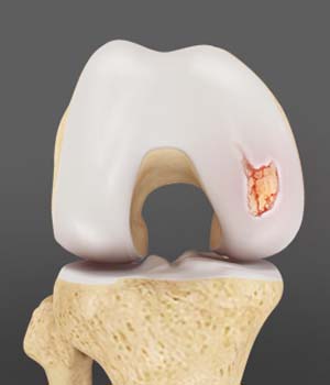 Articular Cartilage Defect