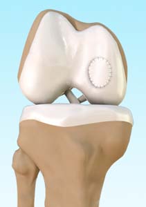 Autologus Chondrocyte Implantation