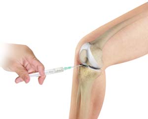 Cortisone Injection