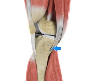 Goosefoot Bursitis of the Knee