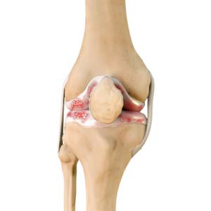 Knee Arthritis