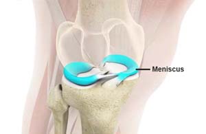 Meniscal Tears