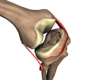 Meniscal Tear