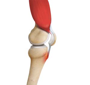 Osgood Schlatter Disease