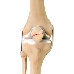 Patella Fracture