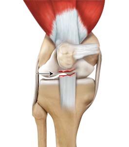 Patella Tendon Rupture