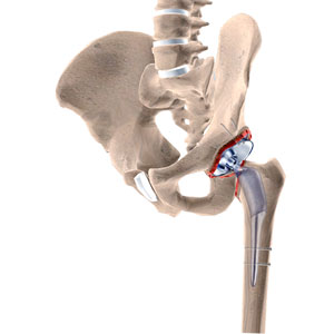 Revision Hip Replacement