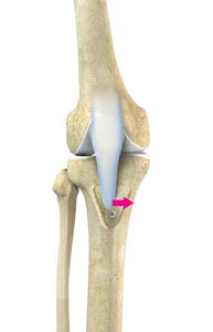 Tibial Tubercle Osteotomy